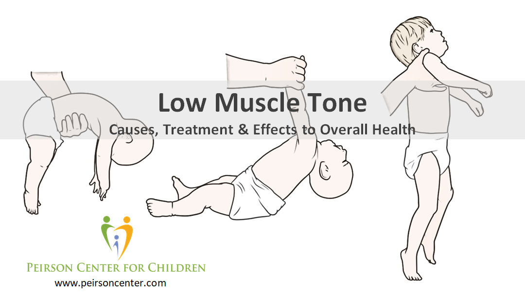 Low Muscle Tone Infants and